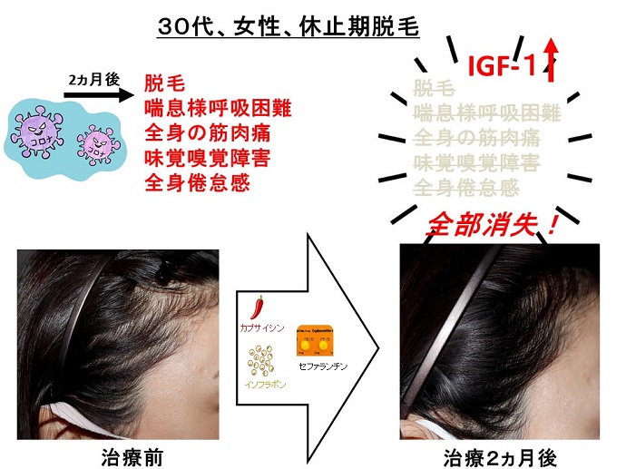 円形脱毛症　病院